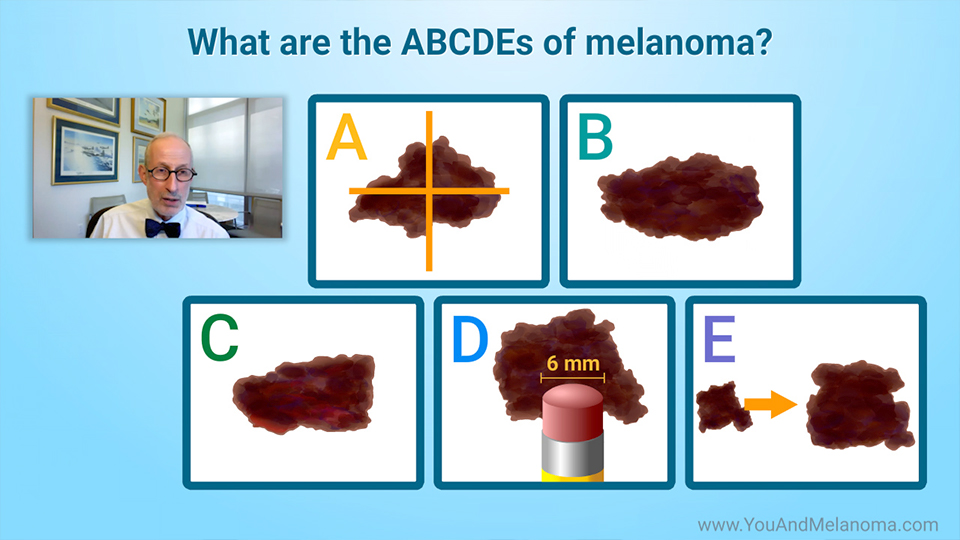 What are the signs and symptoms of melanoma?