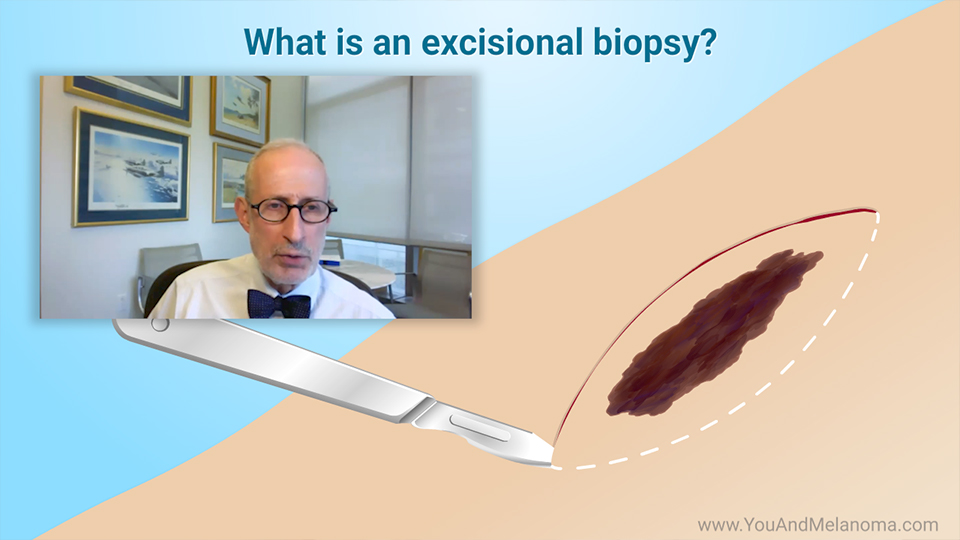 What kind of biopsies are used for melanoma?