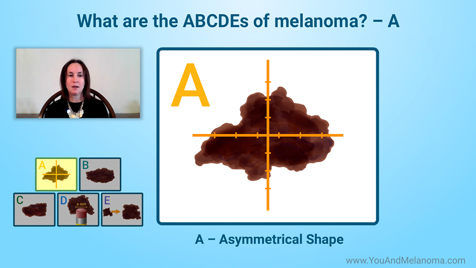 What happens during a physical exam for melanoma?