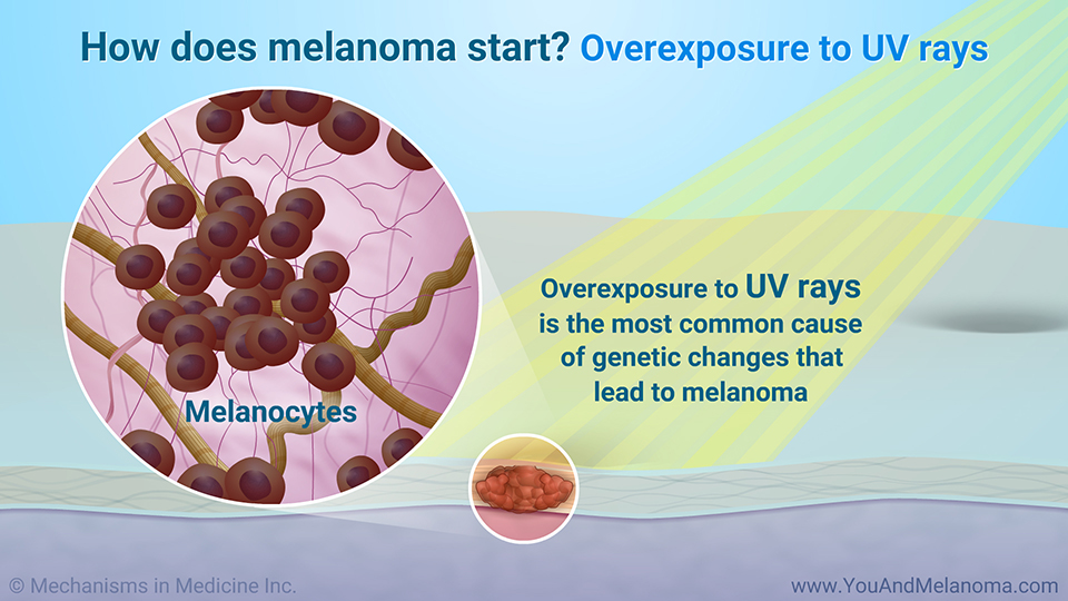 How does melanoma start? Overexposure to UV rays