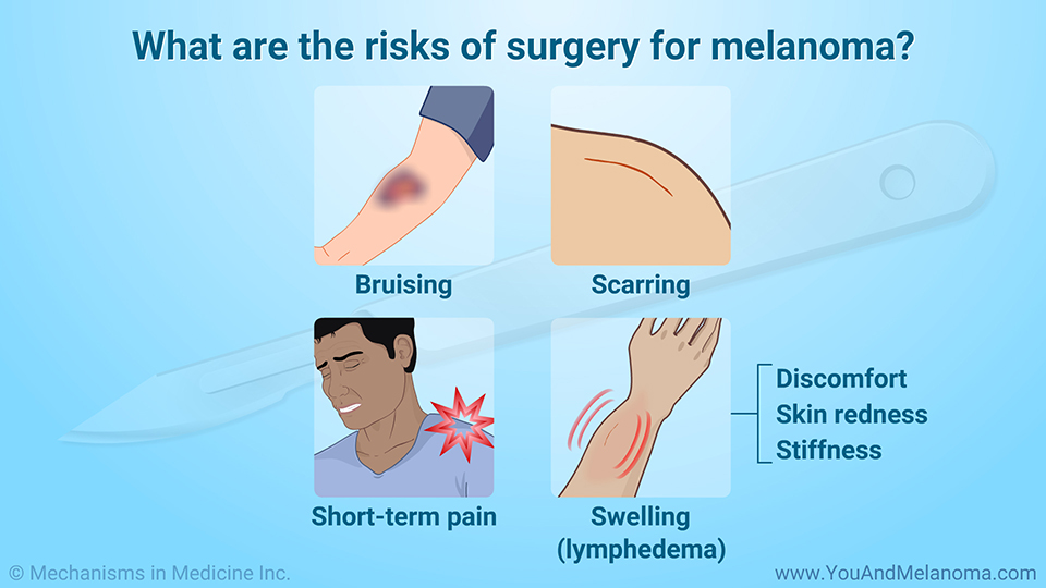 What are the risks of surgery for melanoma?
