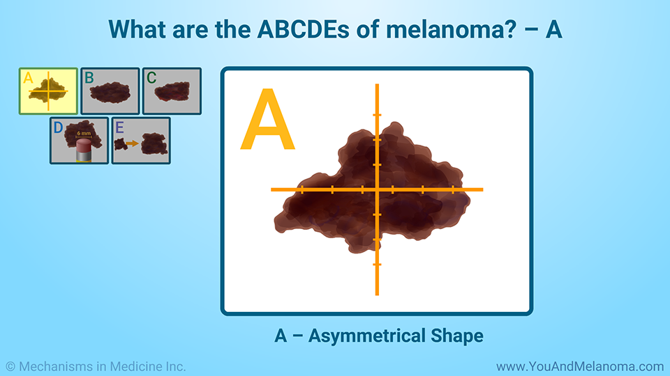 What are the ABCDEs of melanoma? – A