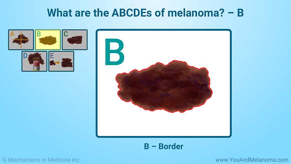 What are the ABCDEs of melanoma? – B