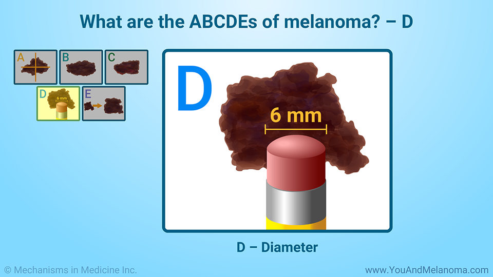 What are the ABCDEs of melanoma? – D