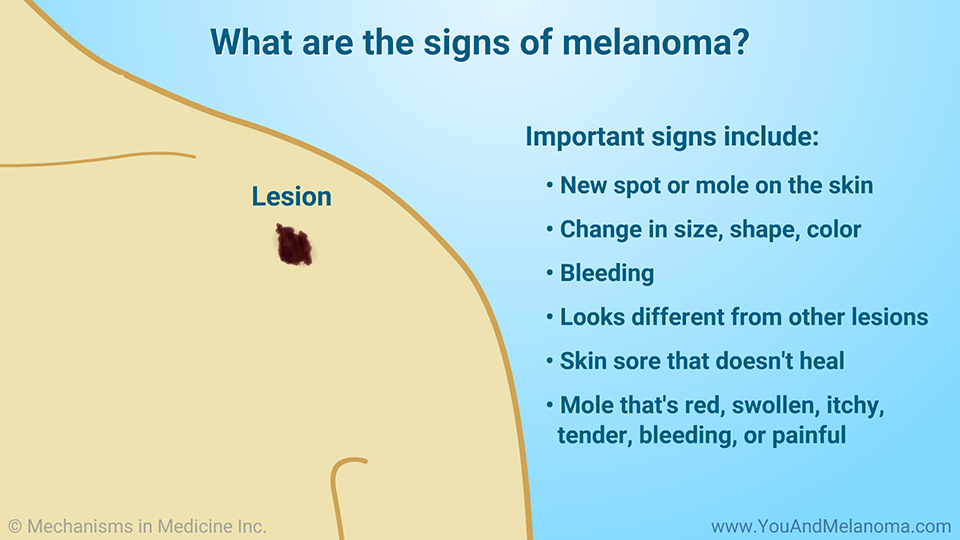 What are the signs of melanoma?