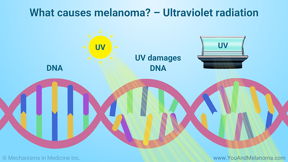 What causes melanoma? – Ultraviolet radiation