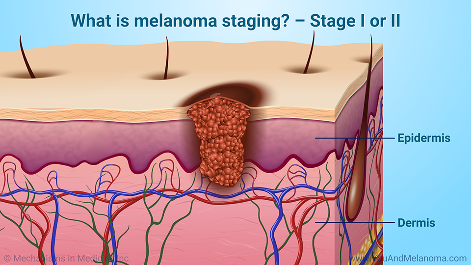 What is melanoma staging? – Stage I or II