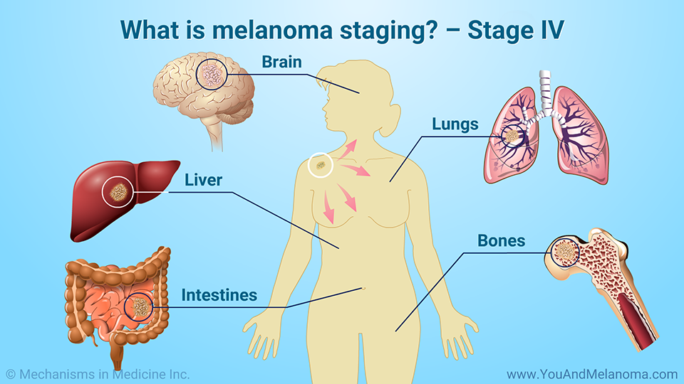 What is melanoma staging? – Stage IV