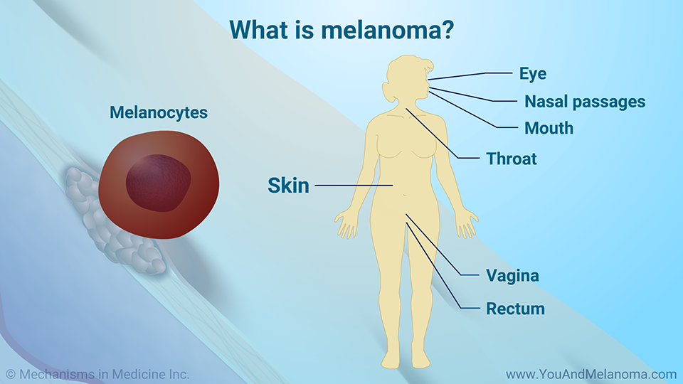 What is melanoma?