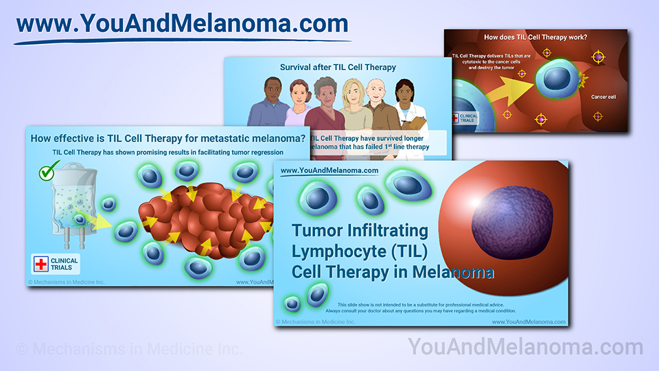 Slide Show - TIL Cell Therapy for Melanoma